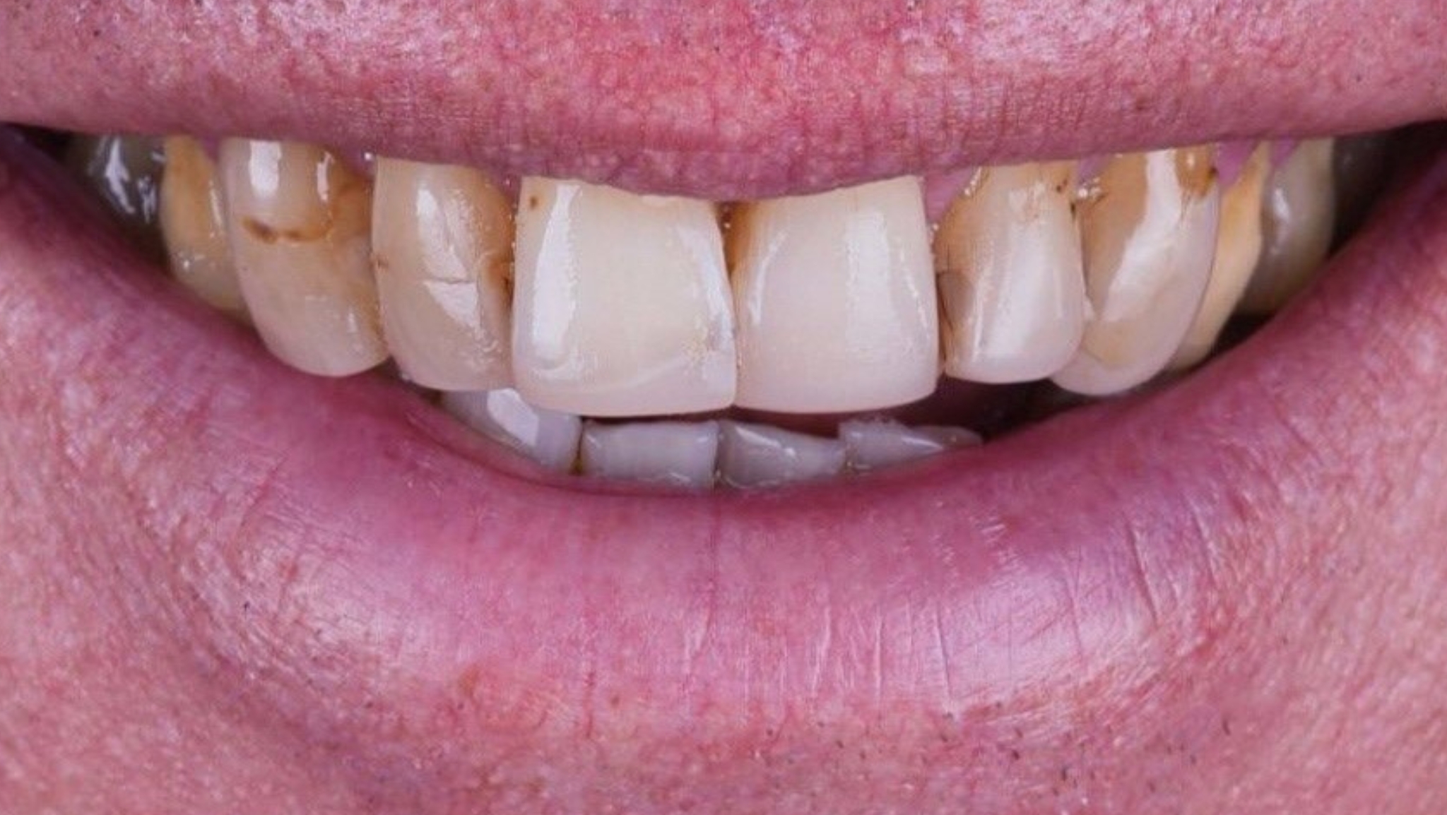 cosmetic dentistry in Fuengirola