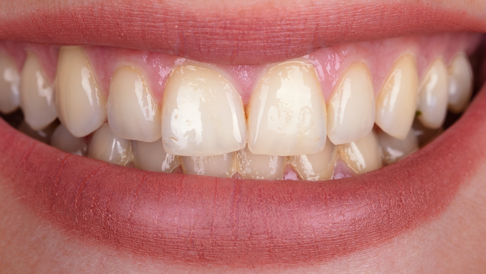 teeth whitening in Fuengirola