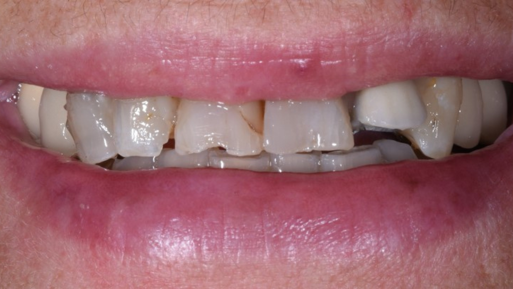 dental veneers in fuengirola