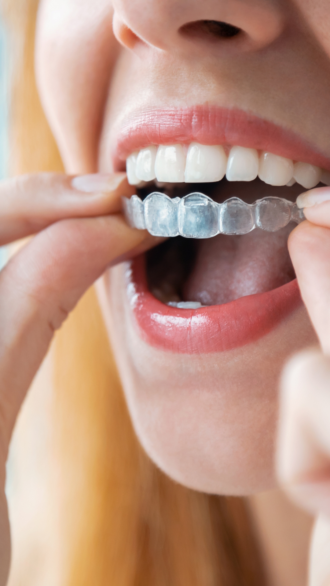 invisible orthodontics in Fuengirola